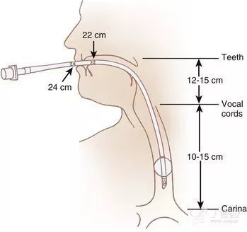 8,固定:确认气管导管插入气管后,立即放置牙垫,然后退出喉镜,用胶布将