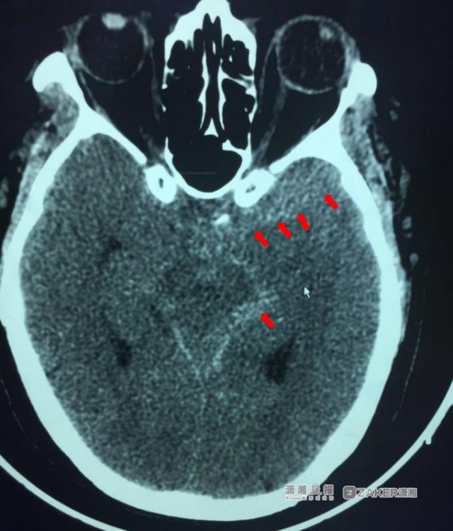 男子反复头痛以为是感冒 十余天后却被告知病