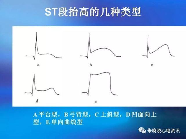 3,病理性q波,st段弓背抬高,st段压低及t波的演变是心肌梗死心电图