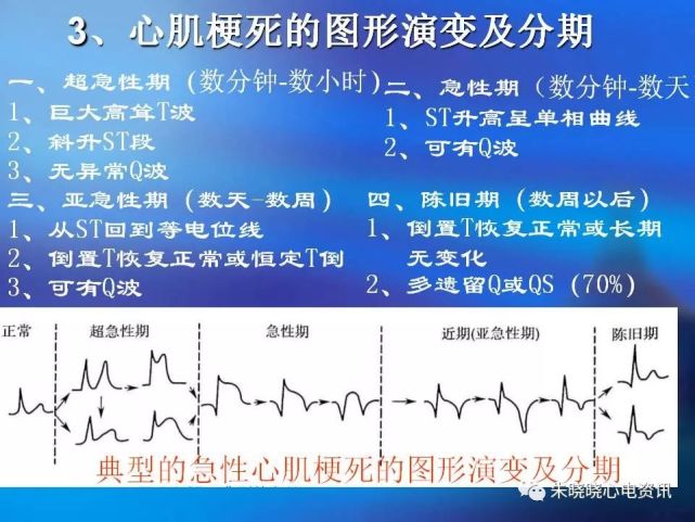 3,病理性q波,st段弓背抬高,st段压低及t波的演变是心肌梗死心电图
