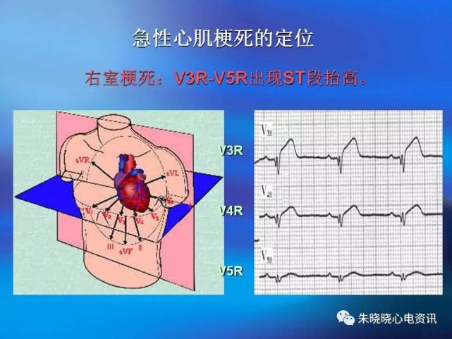 2,心肌梗死的心电图存在时,空的演变,因此导联的固定及及时复查有利于