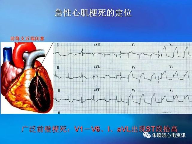 心肌梗死的心电图特点(ppt)