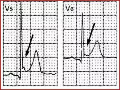 这几种情况可出现心电图 j 波