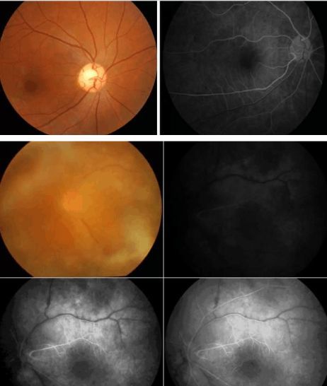 正常眼底及常见异常眼底图分析