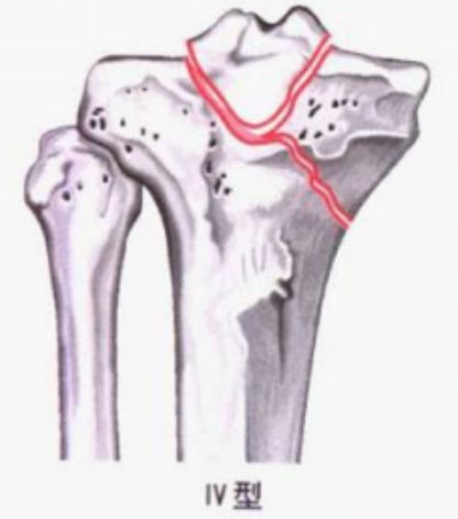 内收型:pauwels角>50度,为极不稳定型 Ⅴ型—双髁骨折.