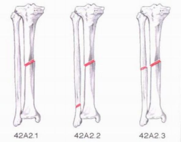 骨科精读|下肢骨折常用分型大全,果断收藏_腾讯新闻