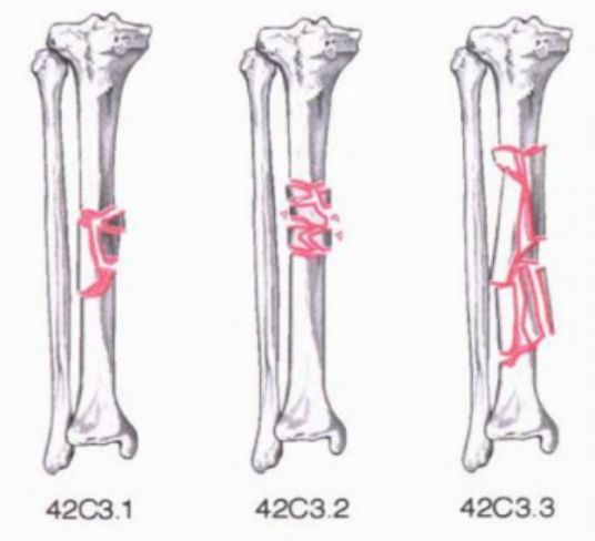 内收型:pauwels角>50度,为极不稳定型 九,胫骨远端骨折pilon骨折分类