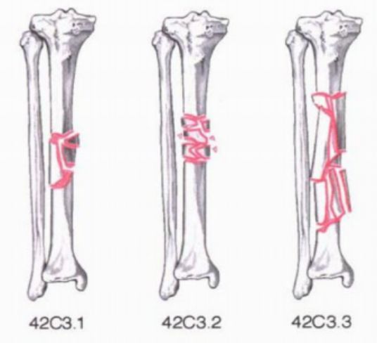 骨科精读|下肢骨折常用分型大全,果断收藏_腾讯新闻