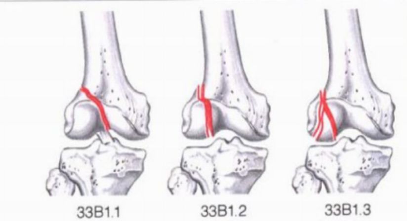 骨科精读|下肢骨折常用分型大全,果断收藏_腾讯新闻