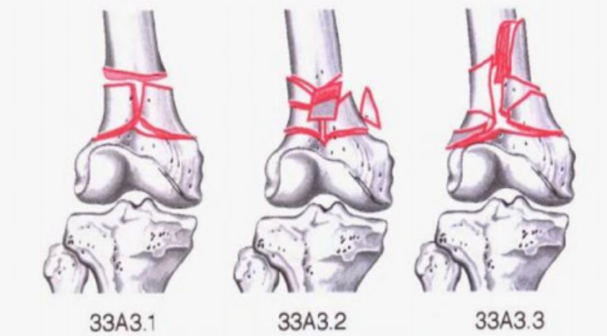 骨科精读|下肢骨折常用分型大全,果断收藏_腾讯新闻