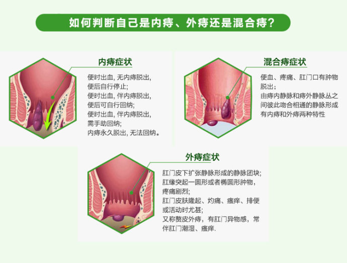 痔疮常常是大家的"难言之隐"?想要摆脱痔尴尬 要学会这2招