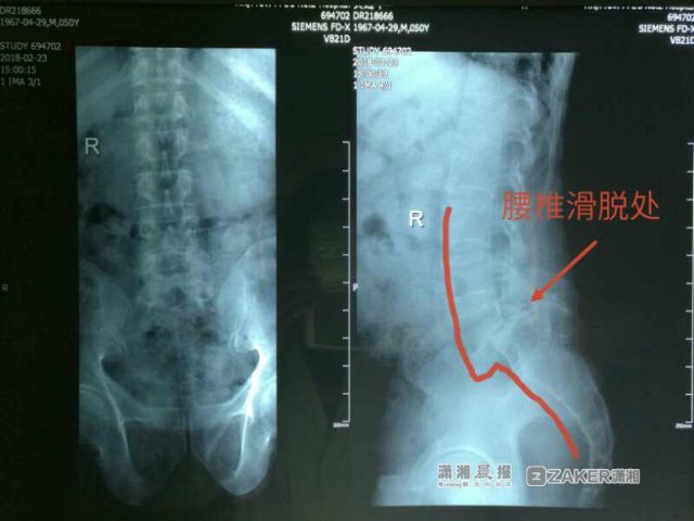 邵阳50岁男子搞装修累到腰椎滑脱 连续27天坐