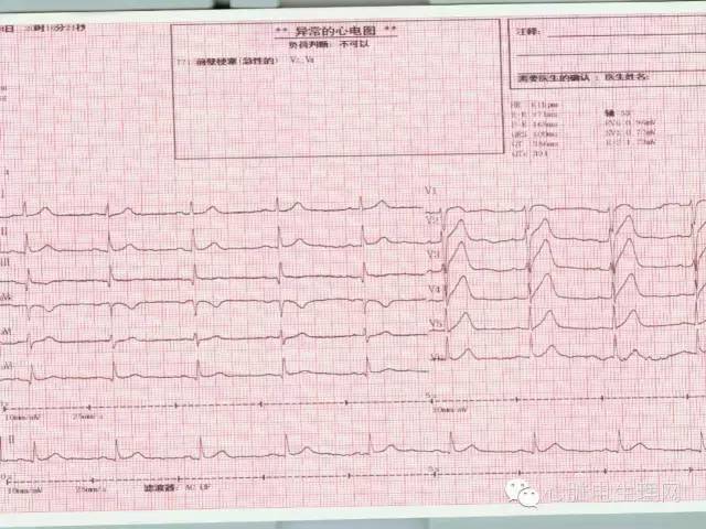 不典型心肌梗死的心电图特点