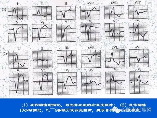 不典型心肌梗死的心电图特点