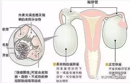 梅州女子腹部疼痛难忍,体内藏了2个巨大畸胎瘤