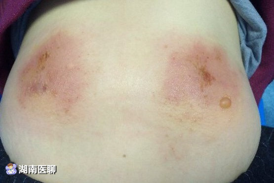 长沙一女子网购工具艾灸祛湿 10天后皮肤烫成