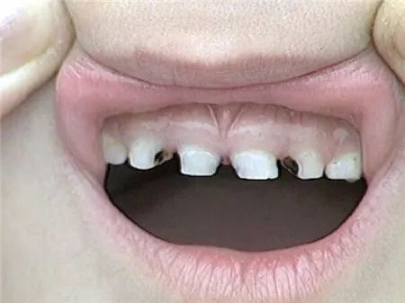 真实病例:还在说乳牙坏了不用管吗?