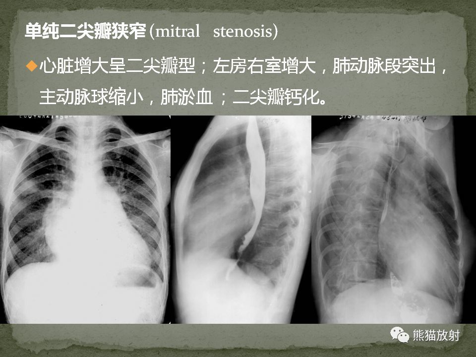 心脏和大血管病变的x线表现