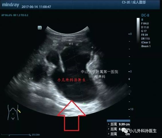 这是手术前的超声图像,中间像猫脚印的黑色部分就是积水,脚掌部分是