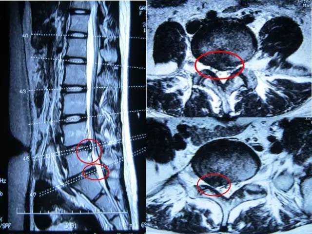 图文并茂!一文读懂腰椎间盘突出症的分型及治疗策略