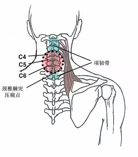 颈椎棘突压痛多见于棘上韧带,亦称项韧带,压痛常见于颈椎3,4,5,6的棘