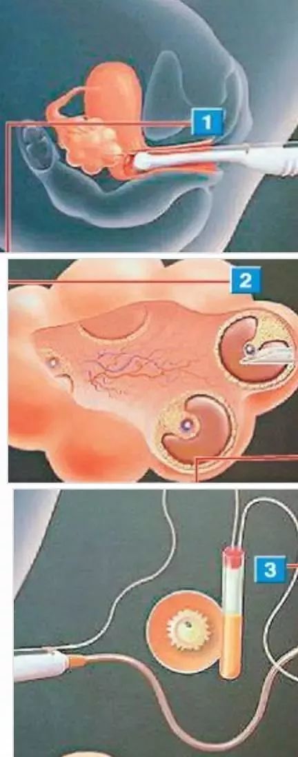 娄底一女子花16万做试管婴儿包生男孩? 取卵全