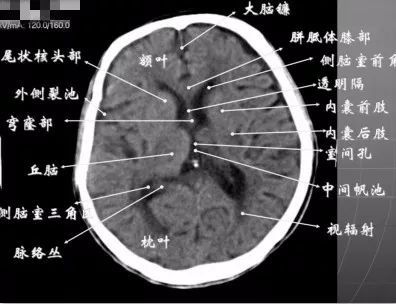 颞,枕叶构成,两侧侧脑室体部之间为透明隔,外侧为尾状核和体部