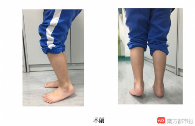 深圳1岁半的宝宝还不会站 检查结果让妈妈大吃一惊