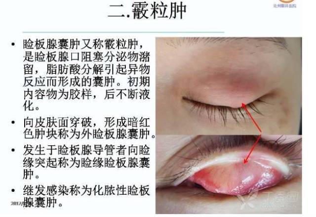 麦粒肿和霰粒肿的个体化分期治疗