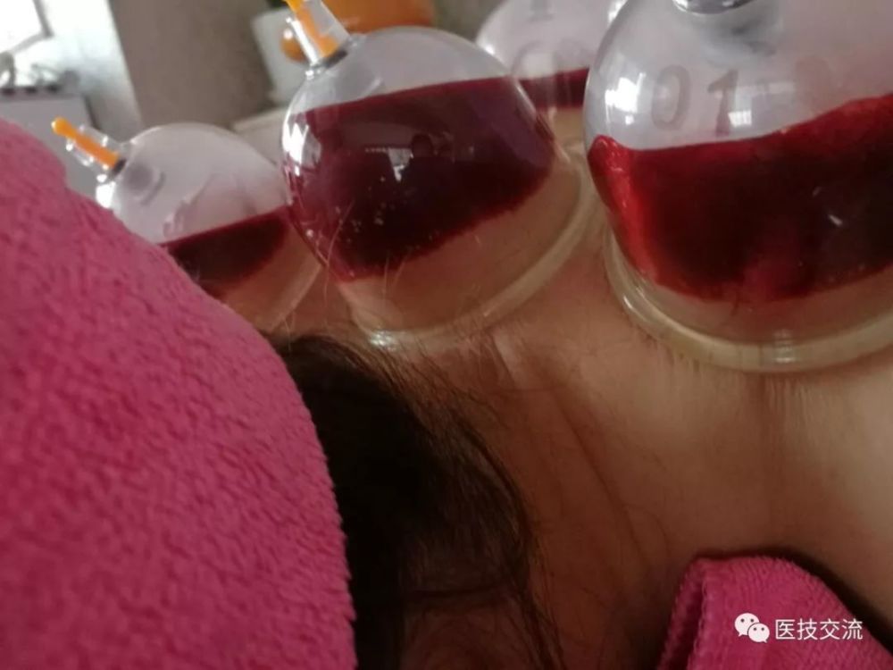 寻找瘀血放血诀窍