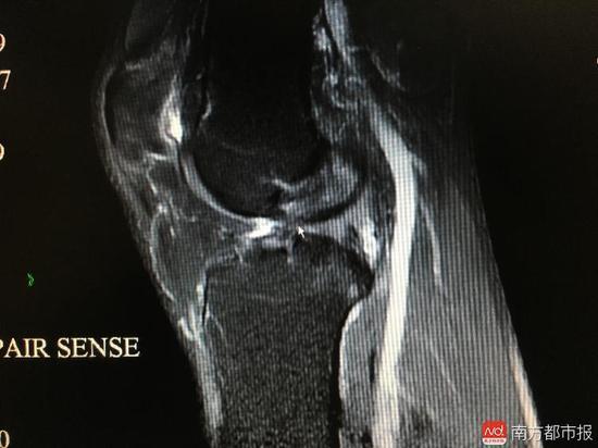 深圳一男子韧带断了20年浑然不知 3年跑18次