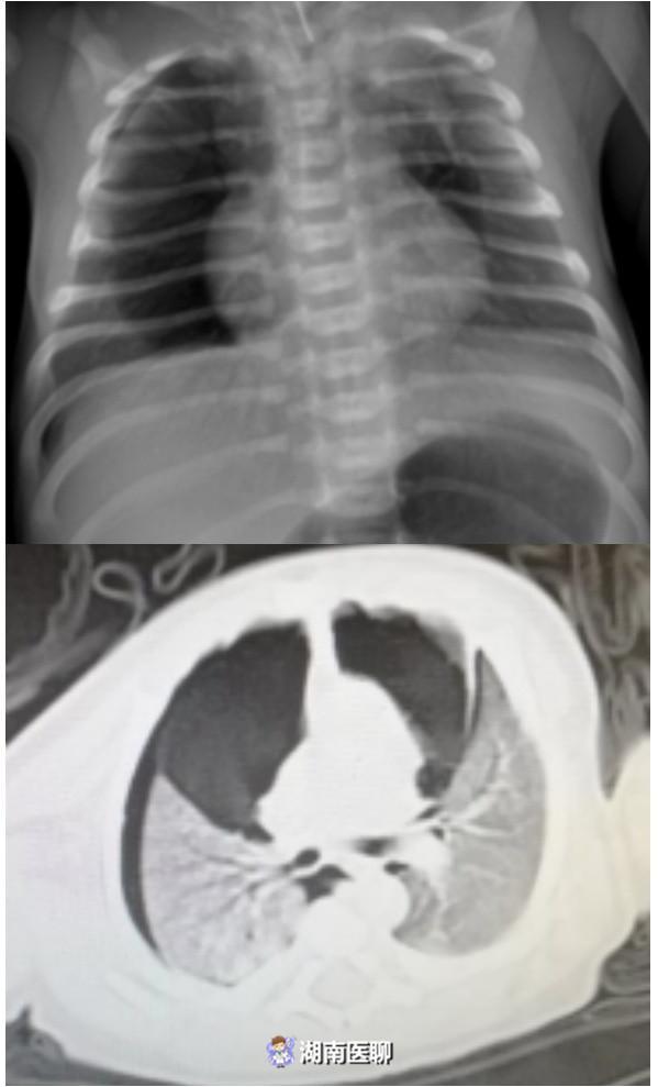 郴州一新生儿肺部破了个洞 一出生就呼吸困难