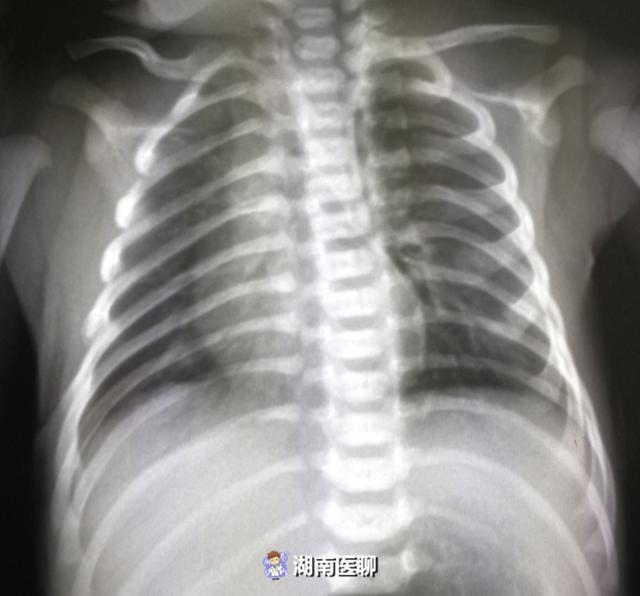 郴州一新生儿肺部破了个洞 一出生就呼吸困难