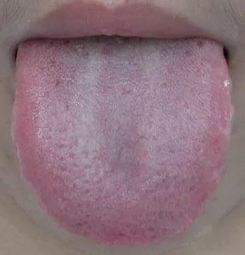 教你从舌苔的5类症状中找出病因附中成药用药方案