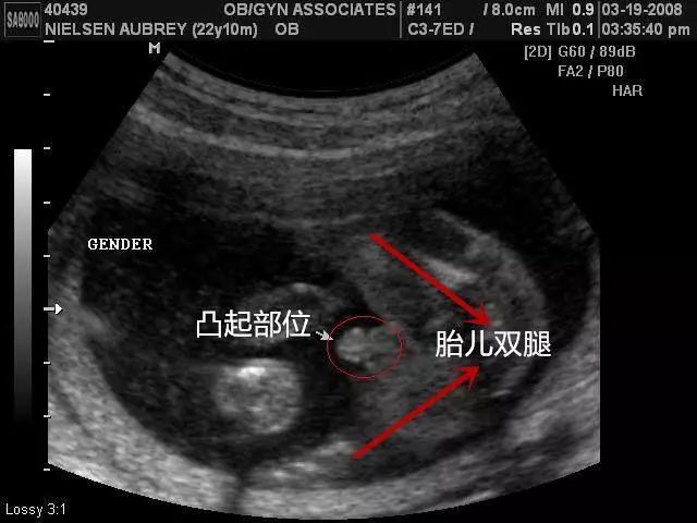 3,从孕囊形状判断,当宝宝还是孕囊阶段的时候,孕囊是长条状,一般认为
