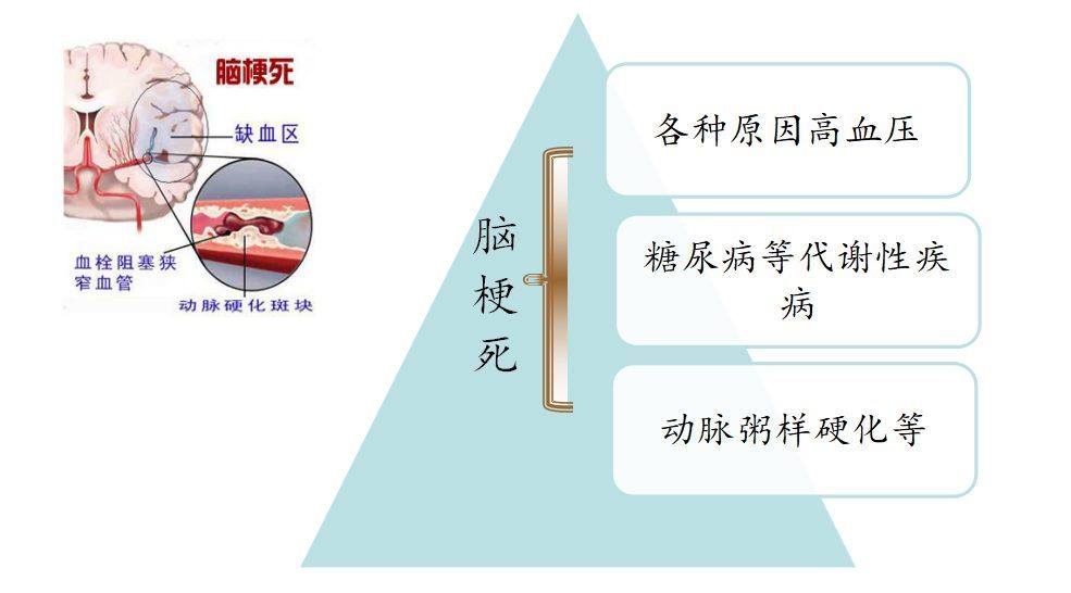 经验分享脑梗死这些知识您都知道吗