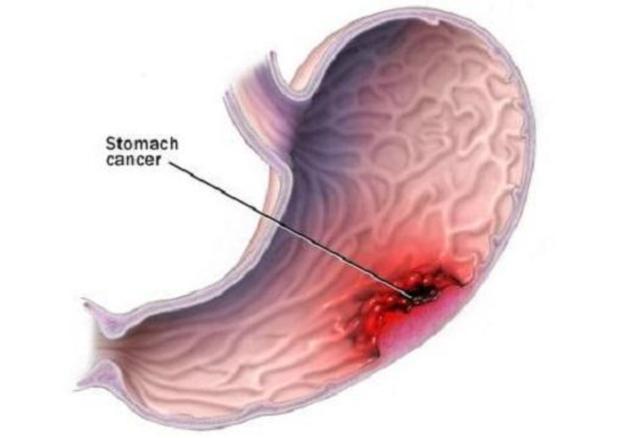 长沙90后美女腹痛查出胃癌 胃里糜烂溃疡坑坑