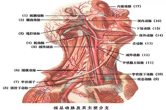 由于异物边缘刺入患者颈总动脉后发生嵌顿,相当于给破裂的血管塞了个