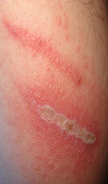 长沙男子穿被隐翅虫爬过的裤子 大腿红肿得像