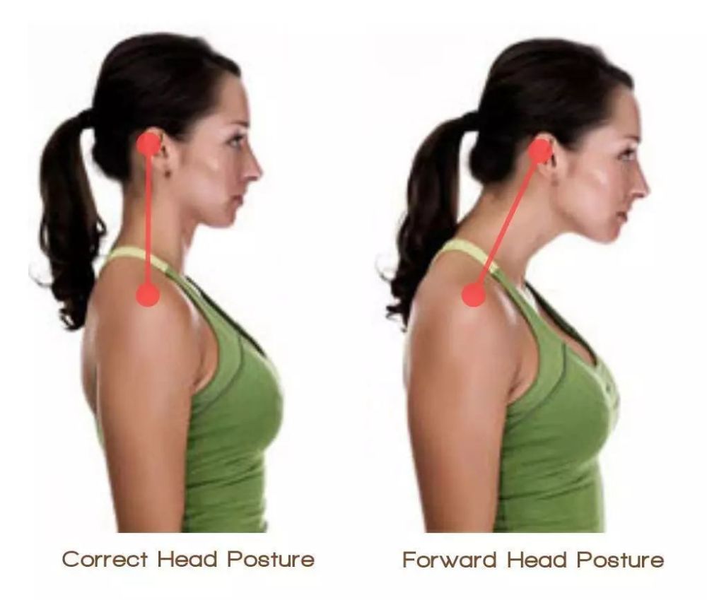 这种驼背,在医学上有个术语叫做颈前屈或颈椎生理曲度变直: 由于长期