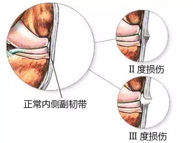 一般内侧副韧带损伤较外侧副韧带损伤多见.