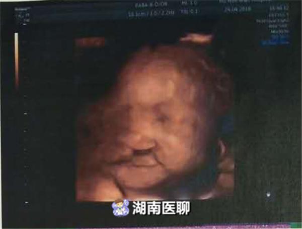 益阳一女子怀孕32周 因孕期抽烟喝酒胎儿患唇