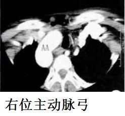 奇怪的奇静脉,在临床中,也不少见.