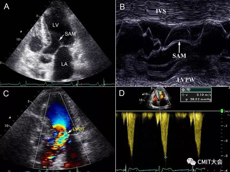 病可以造成左室流出道梗阻,超声可以评估二尖瓣前叶的活动,反应sam征