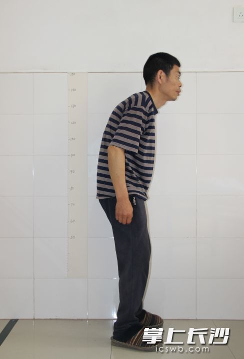 男子90度驼背走路脸朝地 手术后20多年来首次