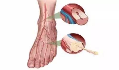 有一种病叫间歇性跛行 疼的是腿,病的是腰!