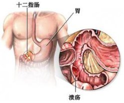 美女因患上男性常见病 医生说这种病女强人也