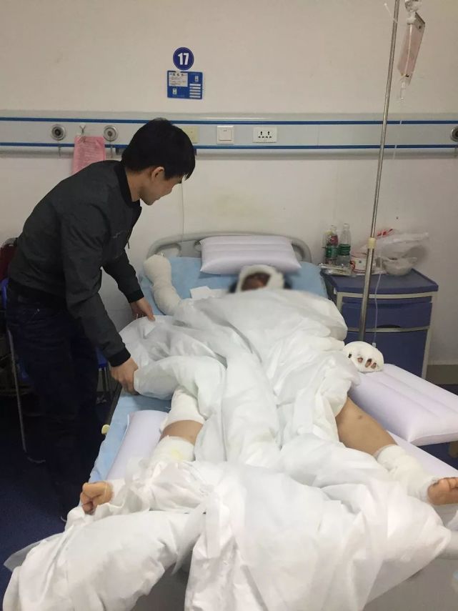 孕妇全身烧伤,为保胎儿拒用止痛药麻醉药