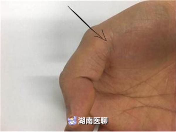 长沙14岁女孩每天刷手机到半夜 大拇指疼不停