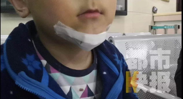 西安8岁男童玩抖音害弟弟下巴缝10针 家长对抖